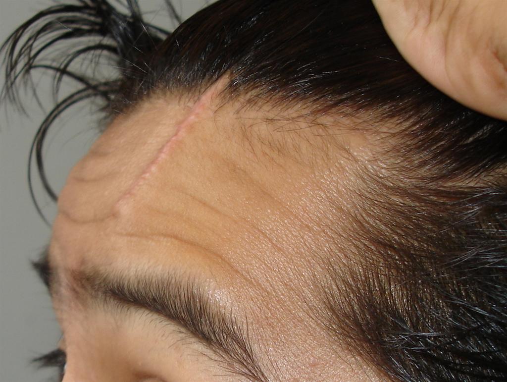 Facial Scar | Missouri Workers Compensation Attorneys